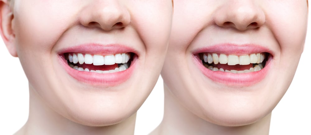 The Ultimate Guide To Safe, Natural Teeth Whitening