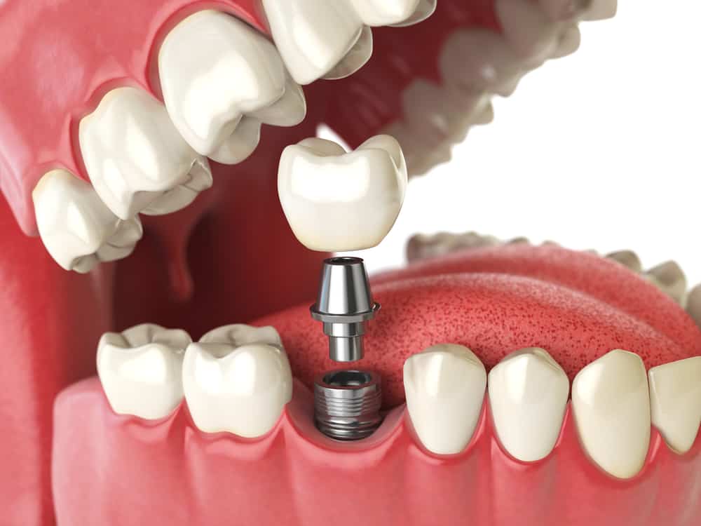 The Complete Guide to Dental Implants: What You Need to Know