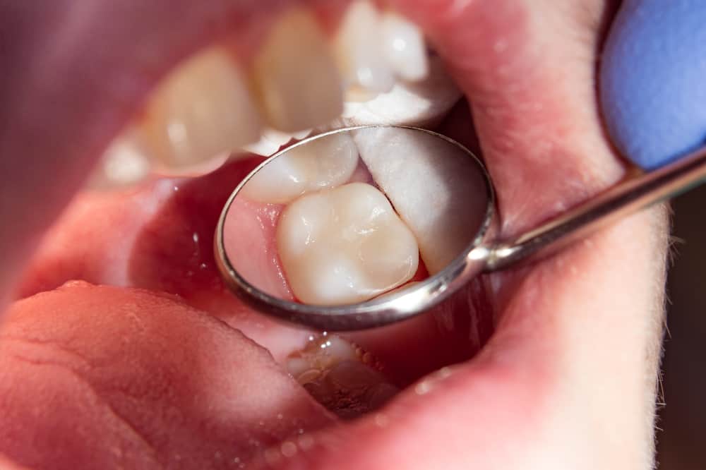 Dental Fillings: A Common and Necessary Dental Treatment