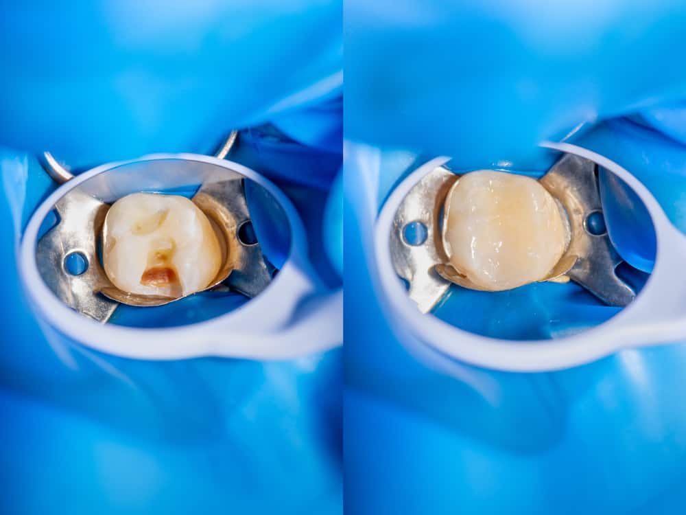 Dental Filling - How long Does it Take?