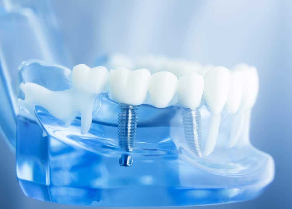How Long Does Dental Implant Procedure Take?