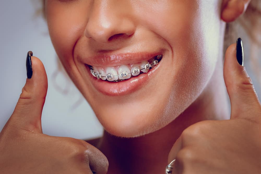 What Are Dental Braces?