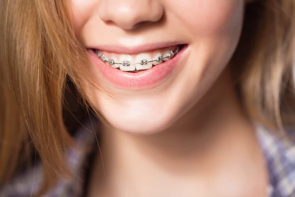 Role of Dental Braces in Orthodontic Treatment